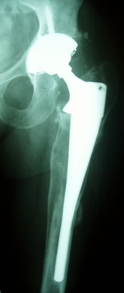 Hip Prostheses:  Total, Revision, Zimmer Bias Stem and HGP II Cup (Implant 408)